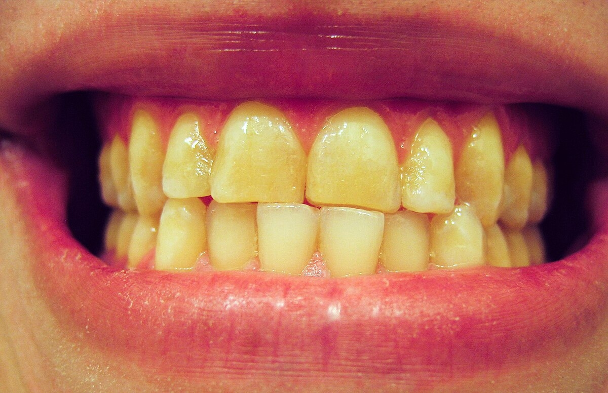 kind of tooth or talk crossword clue