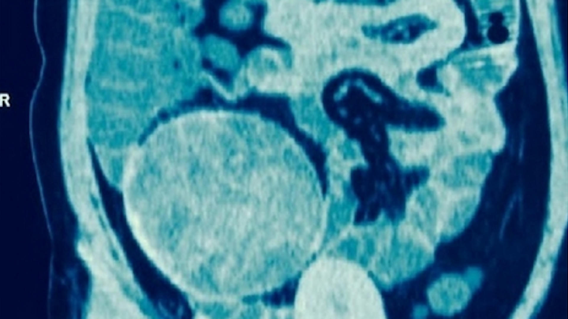 Diagnostic Dilemma Weird Lump In Woman s Hip Was Sponge Left Behind During C section Live Science Diagnostic Dilemma Weird Lump In Woman s Hip Was Sponge Left Behind During C section Live Science