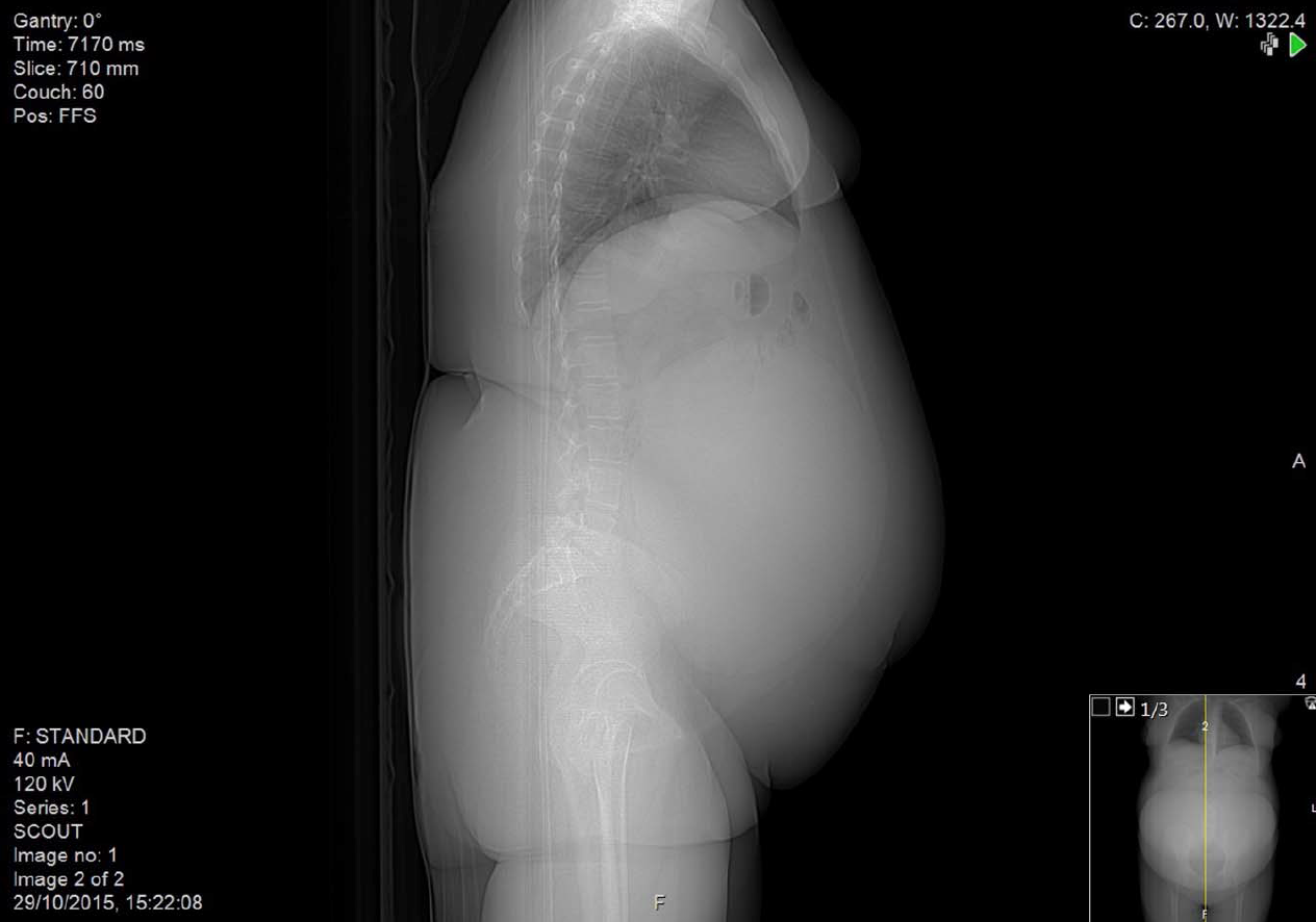 How A Basketball Size Cyst Eluded Doctors Live Science How A Basketball Size Cyst Eluded Doctors Live Science